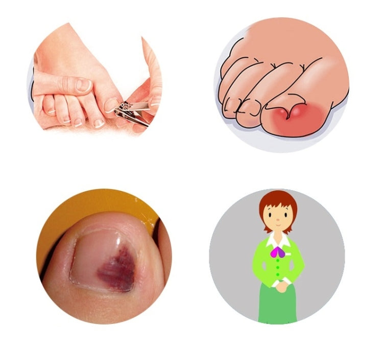 12個/盒 正甲絲甲溝嵌腳趾甲矯正器