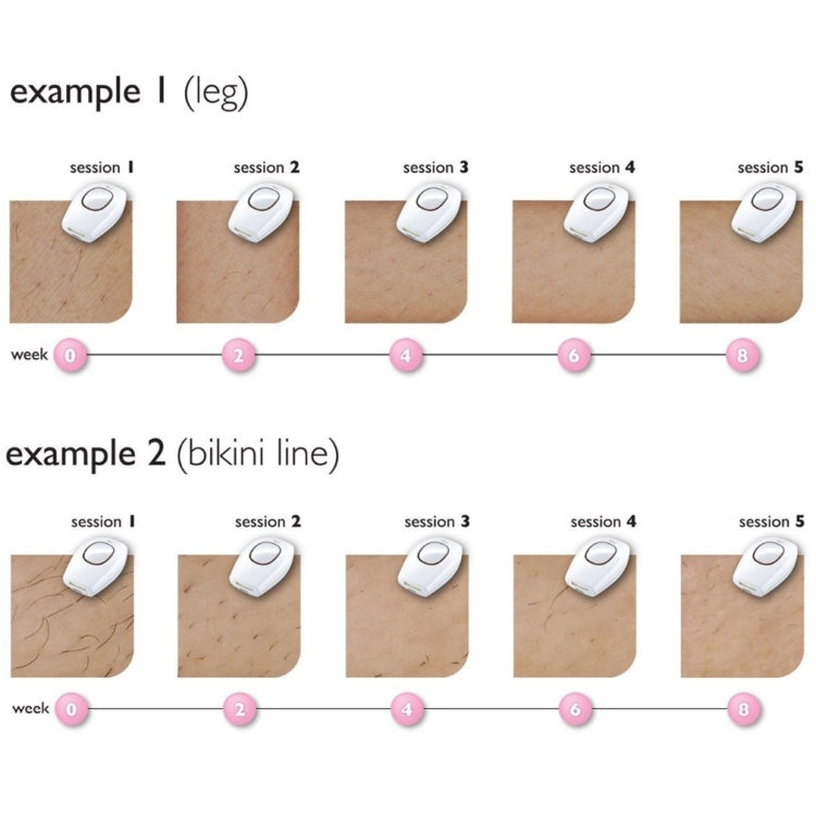 愛滿分 10萬次閃光專業IPL脫毛器 激光脫毛 女士無痛穿線脫毛機